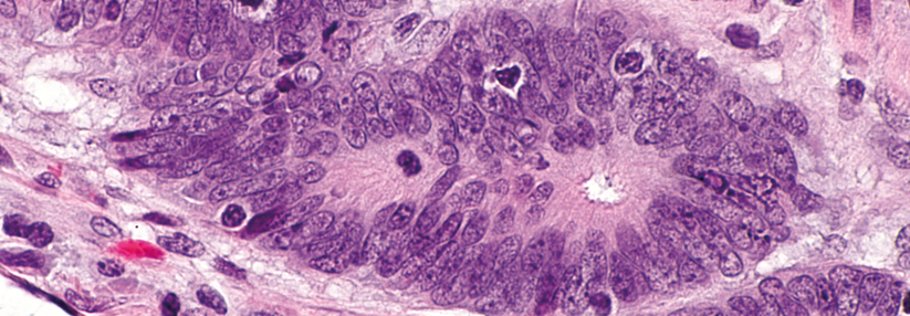 Die Anwesenheit tumor­infiltrierender Lymphozyten bei einem Kolorektalkar­zinom kann für ein Lynch-Syndrom sprechen.