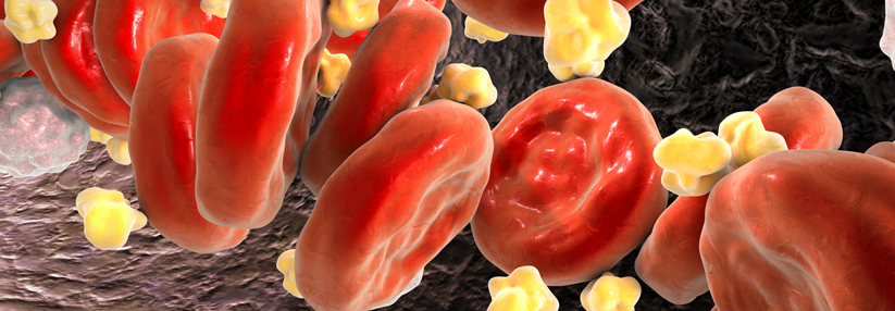 Aufgrund der homozygoten familiären Hypercholesterinämie wird das Cholesterin gar nicht aus dem Blut entfernt.