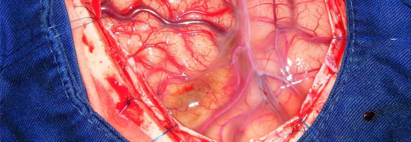 Nicht-rupturierte arteriovenöse Malformation besser konservativ behandeln Besonders aufgrund der Nebenwirkungen ist eine Intervention keine gute Wahl.