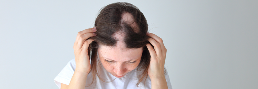 Die Haare fallen durch die Bestrahlung meist nur lokal aus. (Agenturfoto)