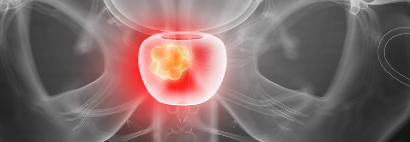 Prostatakrebs: PSA-Abfall nach Androgendeprivation deutet auf günstigeren Verlauf Der PSA-Abfall lässt auf eine bessere Prognose bei Prostatakrebs hoffen.