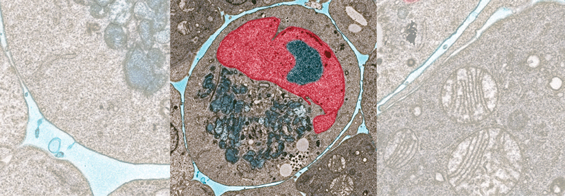 Dieser entartete Leukozyt hat einen stark vergrößerten Nucleus (rot) und sehr aktive Mitochondrien (blau) im Cytoplasma (braun).