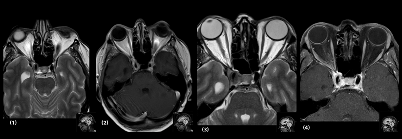 Zu Beginn fiel eine 1–2 mm dicke Gewebsmanschette um die rechte A. carotis interna auf (1) sowie eine Entzündung im Sinus caverosus (2). Nach zwei Monaten hatte sich die Verdickung verschlimmert (3). Zudem lag eine Sinus-Cavernosus-Thrombose vor (4).