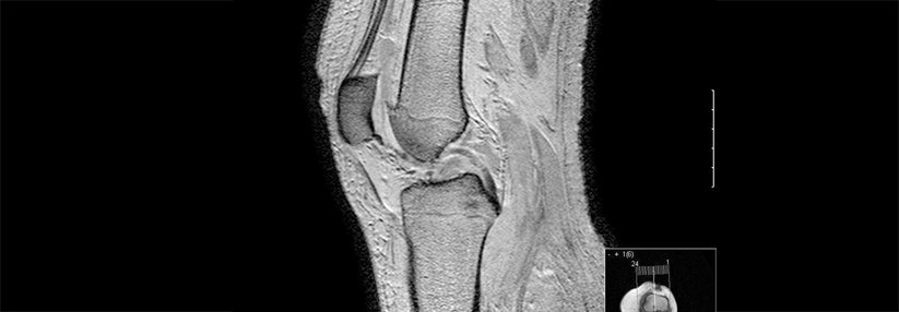 Einen Rückgang arthrosebedingter Knochenschäden kann man von der Arznei wohl nicht erwarten.