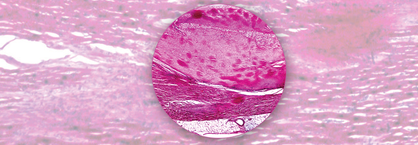 Lichtmikroskopisch sind in der Herzmuskulatur dunkel-pink gefärbte Amyloidablagerungen zu erkennen.
