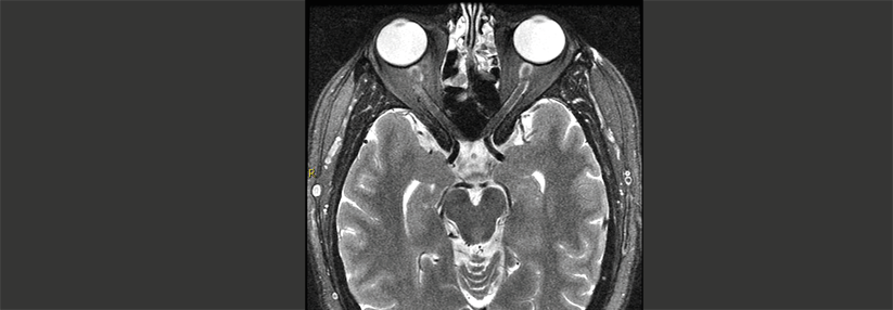 Eine Optikusneuritis (links im Bild) kann quälende Gesichtsschmerzen verursachen.