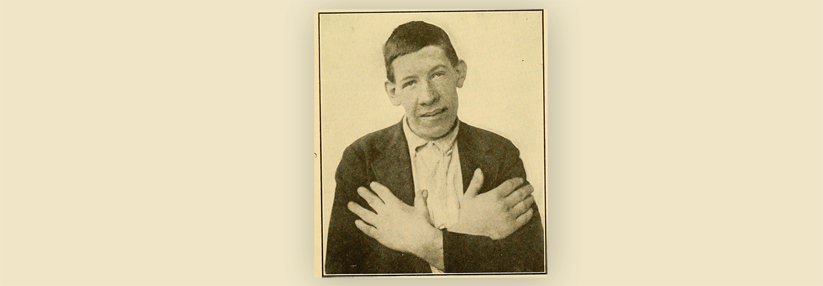 Ein 19-Jähriger mit Akromegalie. Das Foto wurde 1920 aufgenommen.