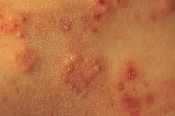 Dermatitis herpetiformis Duhring