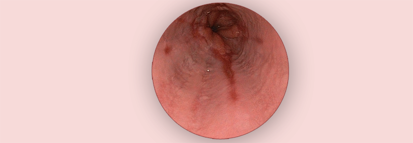 Wenn PPI nicht wirken, kann bei erosiver Ösophagitis ein Säureblocker helfen.