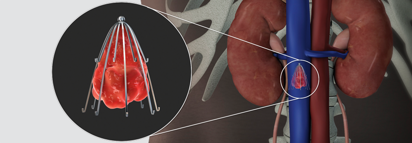 Vena-cava-Filter sollen verhindern, dass Blutgerinnsel aus der ­unteren Körperhälfte in die Lungenstrombahn gelangen.
