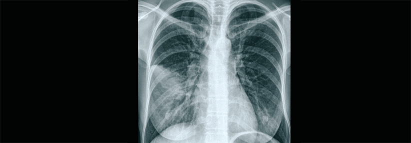 Der Schweregrad einer ambulant erworbenen Pneumonie lässt sich mit dem CRB-65-Score abschätzen.