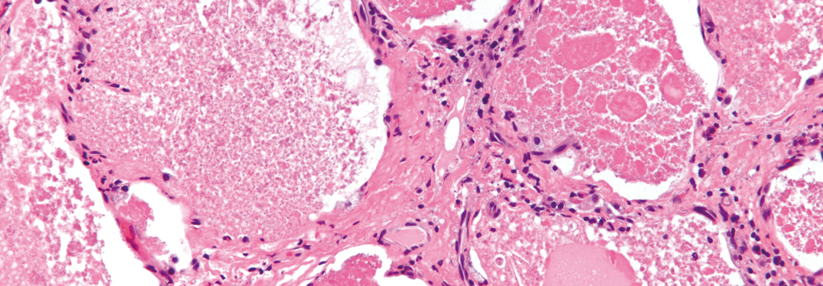 Intraalveolär findet sich ein amorphes eosinophiles feingranuläres Material mit reichlich Lipiden.