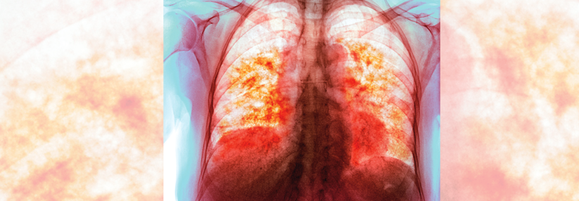 Die chronische Hypersensitivitätspneumonitis kann so schwer verlaufen wie die idiopathische Lungenfibrose.