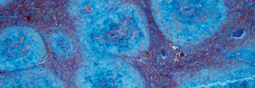 Die Amyloidablagerungen (blau) verdrängen das funktionelle Gewebe, hier in der Milz.