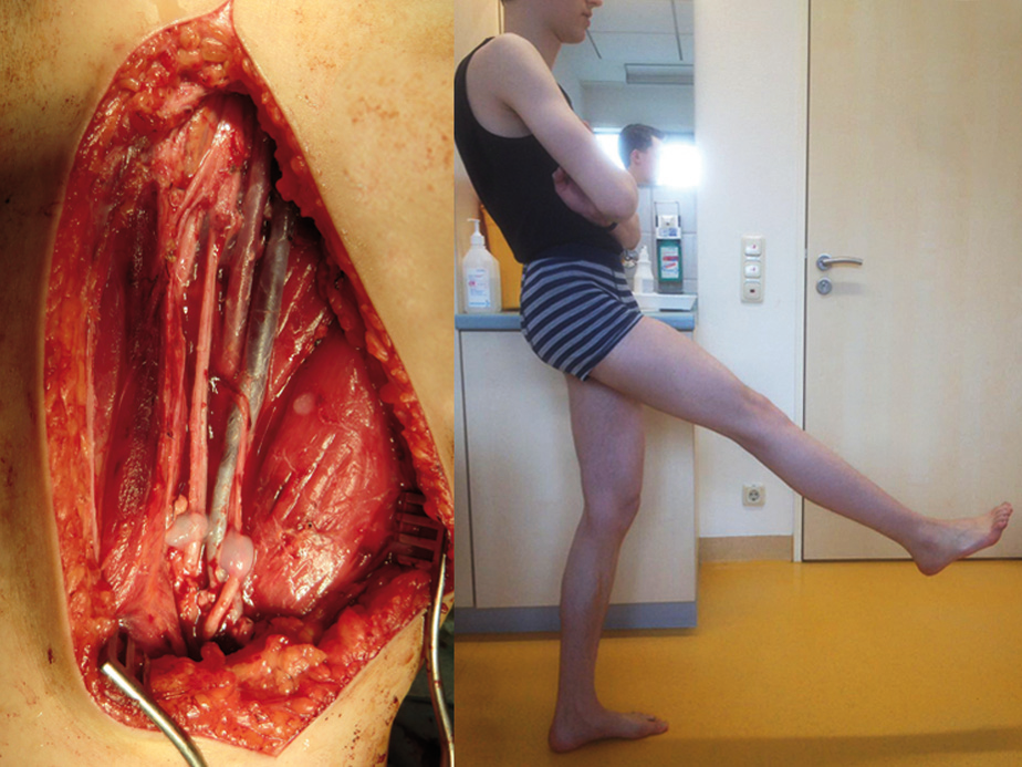 Einer Sarkomresektion fielen N. femoralis und N. saphenus zum Opfer. Dank einer Nervenrekonstruktion kann der Junge sein Bein wieder heben.