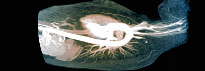 Eine weitere Art der Großgefäßvaskulitis ist die Takayasu-Arteriitis.