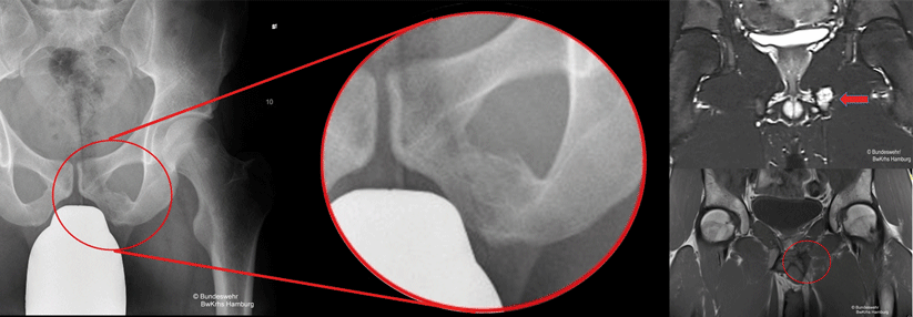 Röntgenologisch zeigt sich im Sitzbein eine tumoröse Auftreibung mit angedeuteter Periostreaktion (Abb. 1). Im Kontrastmittel-MRT stellt sich im Os ischii eine hypodense Läsion dar (Abb. 2). Das postoperative MRT ergibt keine Hinweise auf ein Rezidiv (Abb. 3).
