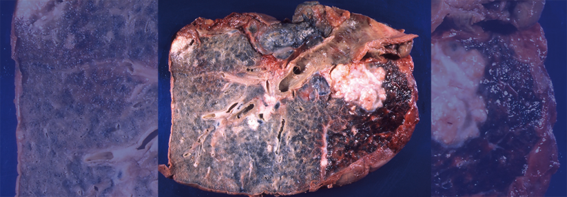 Ursprung dieses Karzinoms war wohl der Bronchus. Der Tumor reicht tief ins Parenchym, die Pleura ist ebenfalls betroffen.