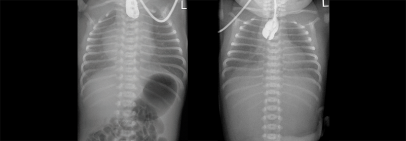 Viel (links) beziehungsweise keine Luft (rechts) im 
Magen-Darm-Trakt aufgrund einer Ösophagus­atresie.