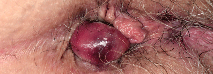 Perianalthrombosen bilden sich durch Gerinnsel im Hämorrhoidalplexus.