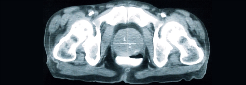 Nicht immer stimmt die im MRT ermittelte Größe mit dem tatsächlichen Umfang des Prostatakrebses überein.