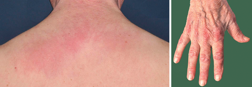 Erytheme an Dekolleté und Nacken sind typisch für die Dermatomyositis. Über den proximalen und distalen Interphalangealgelenken sieht man sowohl Gottron’sche Papeln als auch das Gottron‘sche Zeichen.