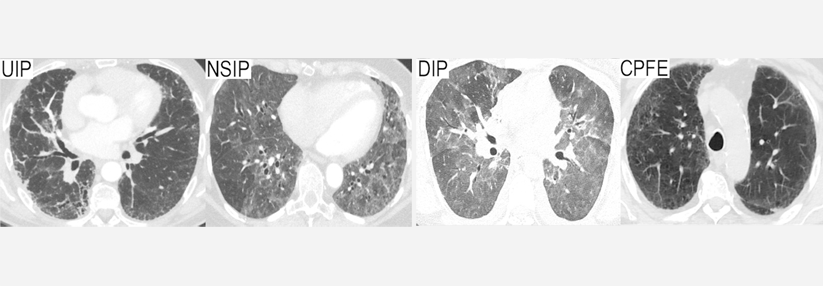 CT-Befunde von vier pSS-Patienten mit 
Lungenbeteiligung: UIP = usual interstitial 
pneumonia; NSIP = non-specific interstitial pneumonia; DIP = desquamative interstitial pneumonia; CPFE = combined pulmonary fibrosis and emphysema