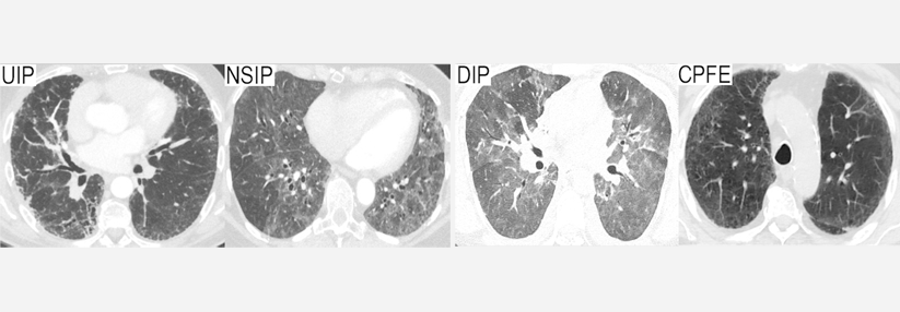Extraglandulären Sjögren wie Lupus behandeln