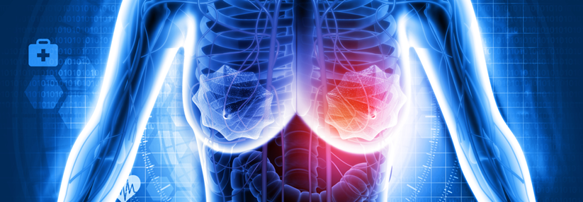Brustkrebs: PD1-Hemmer punktet unabhängig vom Chemotherapie-Partner Unabhängig von der Chemotherapie zeigt Pembrolizumab Wirkung.