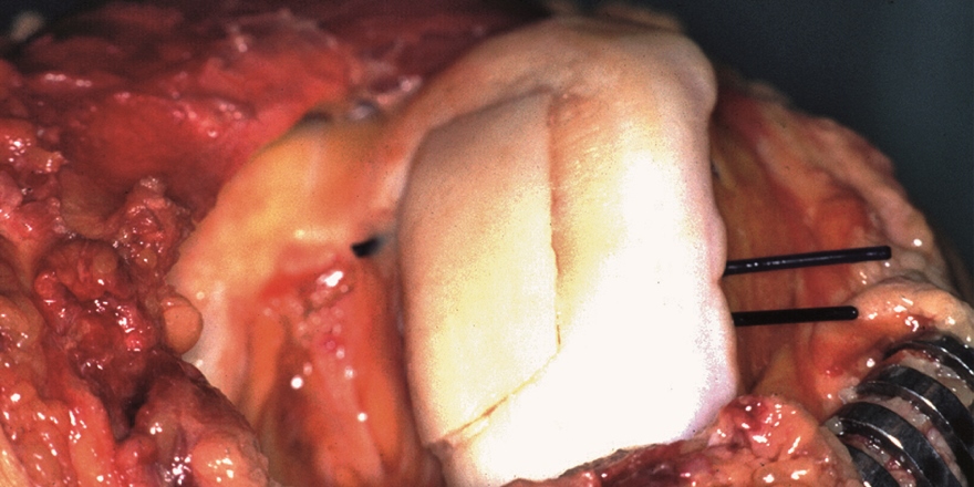 Arthrose: Gelenkreparaturen unter der Lupe Ein Allograft ersetzt den beschädigten Knorpel.