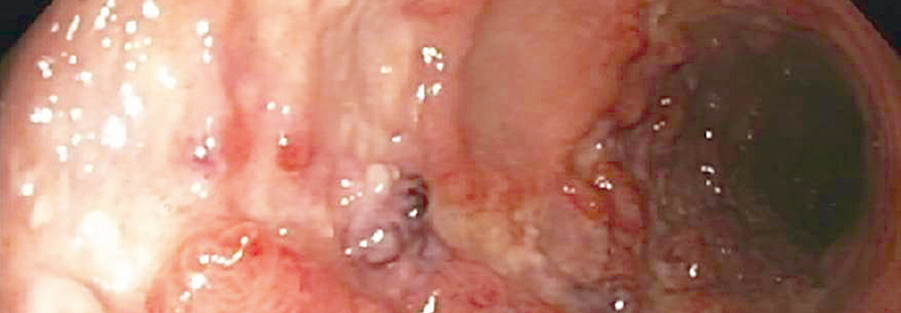 Histologisch gesicherte CMV-Colitis bei einer 67-jährigen Patientin mit C. ulcerosa, aufgetreten unter der Behandlung mit Azathiopri