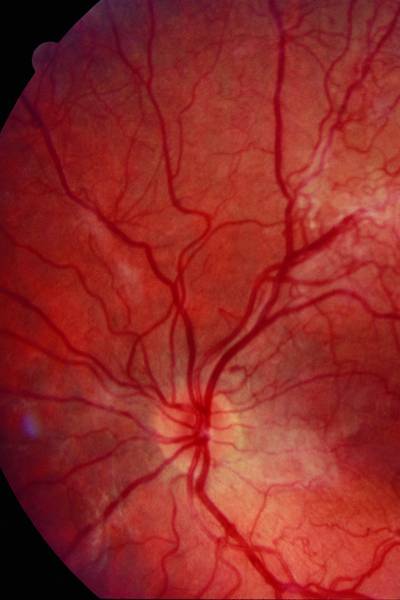 Bei der proliferativen
diabetischen Retinopathie bilden sich krankhafte neue Gefäße auf der Netzhautoberfläche oder am Sehnerv.