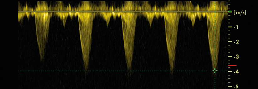 Die Doppler-Sonographie entlarvt die pathologischen Druckgradienten z.B. über dem linksventrikulären Ausflusstrakt.