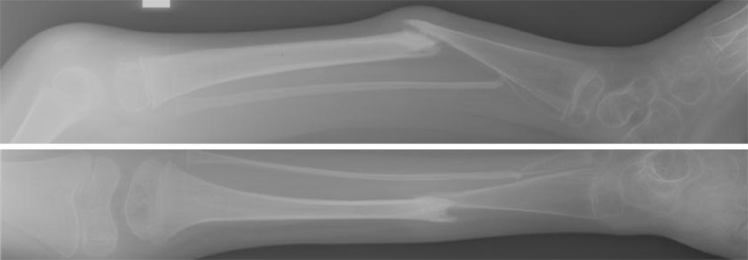 Keine Misshandlung, sondern eine Fehlbildung: die kongenitale Tibiapseudoarthrose.