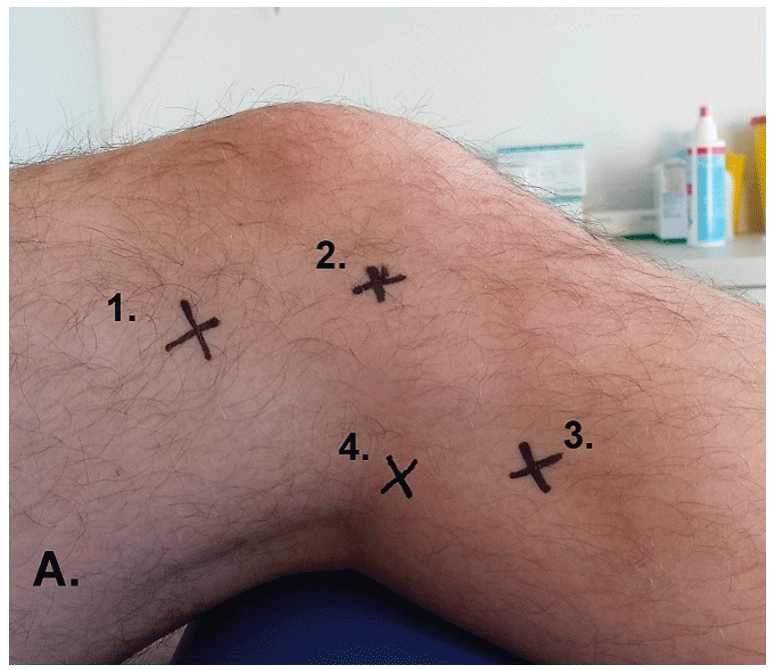 Ansicht lateral: 1. Tractus iliotibialis, 2. lateraler Gelenkspalt, 3. Fibulaköpfchen, 4. M. Popliteus