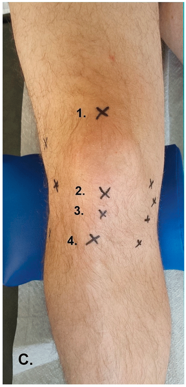 Ansicht frontal: 1. proximaler Patellapol/Quadricepssehne, 2. distaler Patellapol, 3. Patellasehne, 
4. Tuberositas tibiae