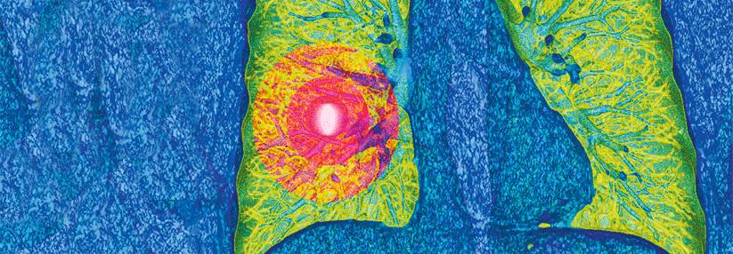 Nutzen des Screenings mittels Niedrigdosis-CT überwiegt wohl Risiko - Effektive Strahlung über 10 Jahre ermittelt