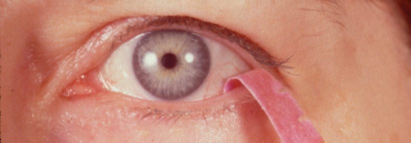 Der Schirmer-Test mit einem Lackmusstreifen objektiviert die Reizsekretion des Auges.