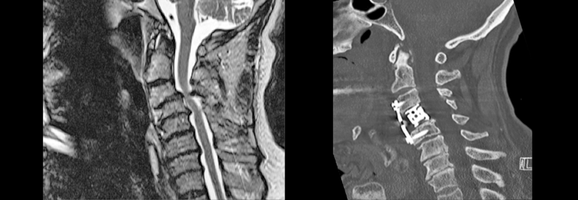 Bei zervikaler Spinalkanalstenose auf Warnsignale der Myelopathie achten!