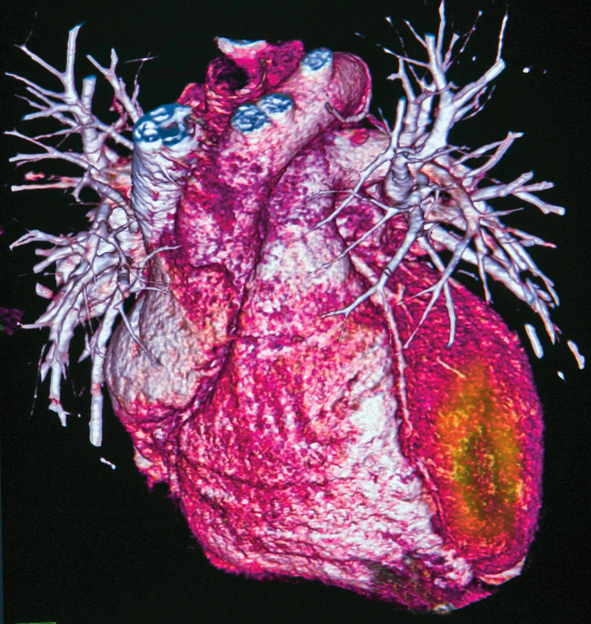 Die Rolle des Troponin zur Infarktdiagnostik Im Infarktareal (gelb) kommt es zu einer Troponin-Leckage.
© thinkstock