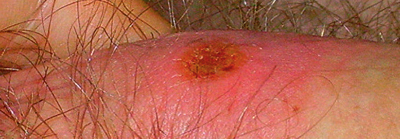 Ein im Randbereich verhärteter Ulkus – hier auf der Penis­unterseite – ist charakteristisch für eine Syphilis im Primärstadium.