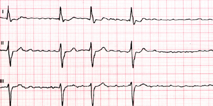 Tachyarrhythmia Absoluta bei einem Patient mit Vorhofflimmern
© thinkstock