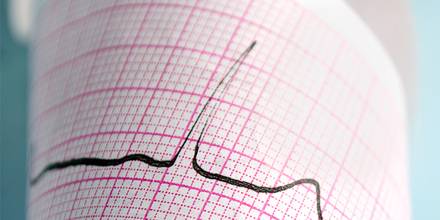 Neue Leitlinie SVT stärkt Rolle der Katheterablation
© thinkstock