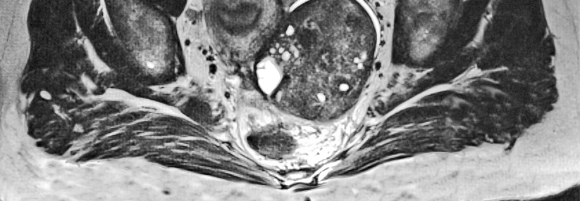 Beim BRCA-mutierten Ovarial-Ca sind PARP-Inhibitoren vielversprechend.