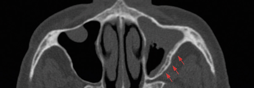 Die ossäre Verdickung (Pfeile) weist auf einen chronischen Entzündungsprozess im Sinus maxillaris hin.