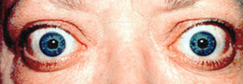 Hyperaktivität beim Basedow ausbremsen Endokrine Orbitopathie mit Lidretraktion und Exophthalmus.