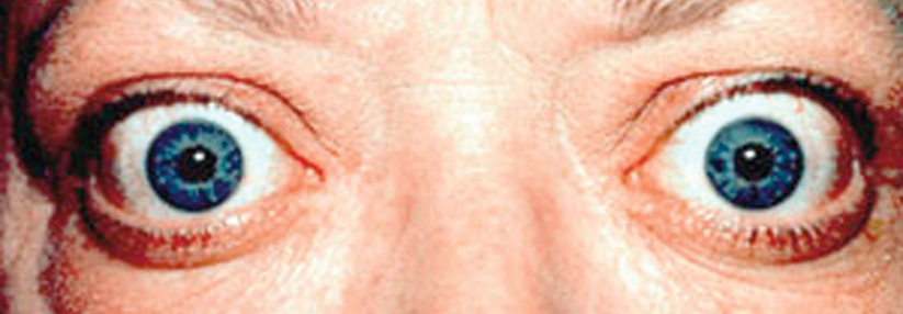 Endokrine Orbitopathie mit Lidretraktion und Exophthalmus.