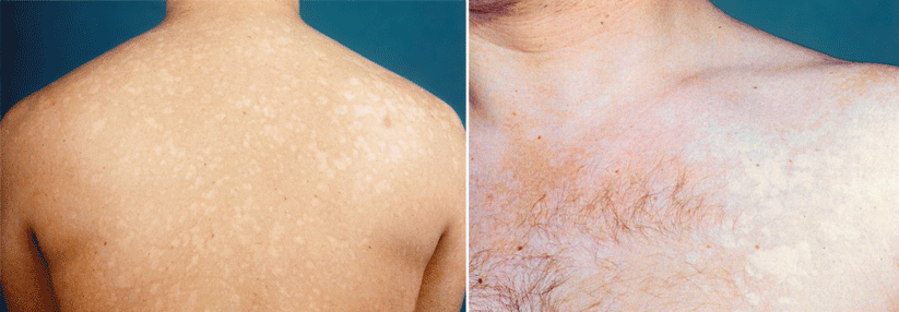 Der Kleienpilzflechte eine kleben Die Pityriasis versicolor alba macht sich durch typische hypopigmentierte Areale bemerkbar – bei diesem jungen Mann an Brust und Rücken.