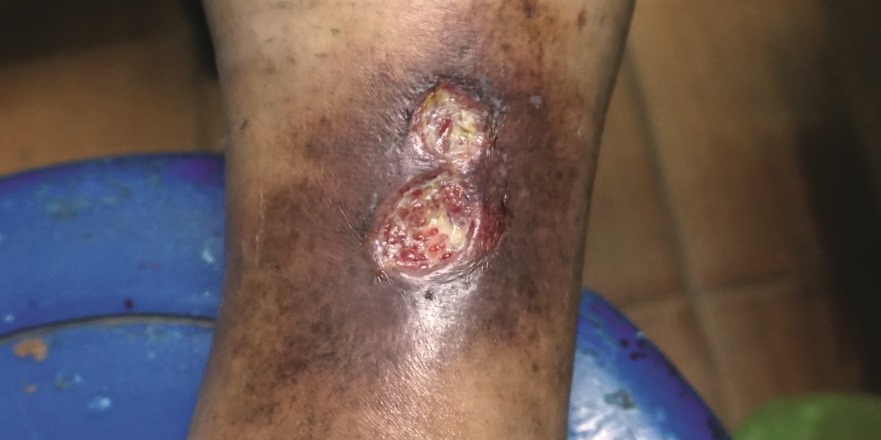 Ulcus cruris Vor der Therapie eines Ulcus cruris gilt es zunächst, die venöse Genese sicherzustellen und eine pAVK als Ursache auszuschließen.