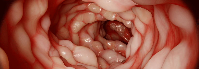 Für Patienten mit Morbus Crohn könnte es bald eine neue Therapieoption geben.